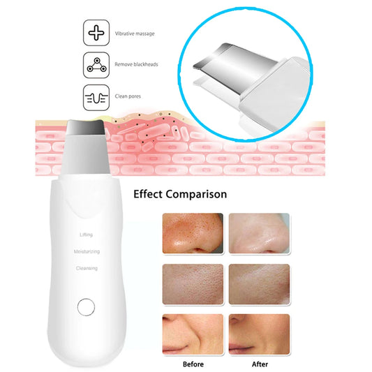 Ultrasonic Skin Scrubber Electric Ultrasonic Peeling Machine Deep Vibrate Facial Cleaner Acne Removal Blackhead Pore Cleaner
